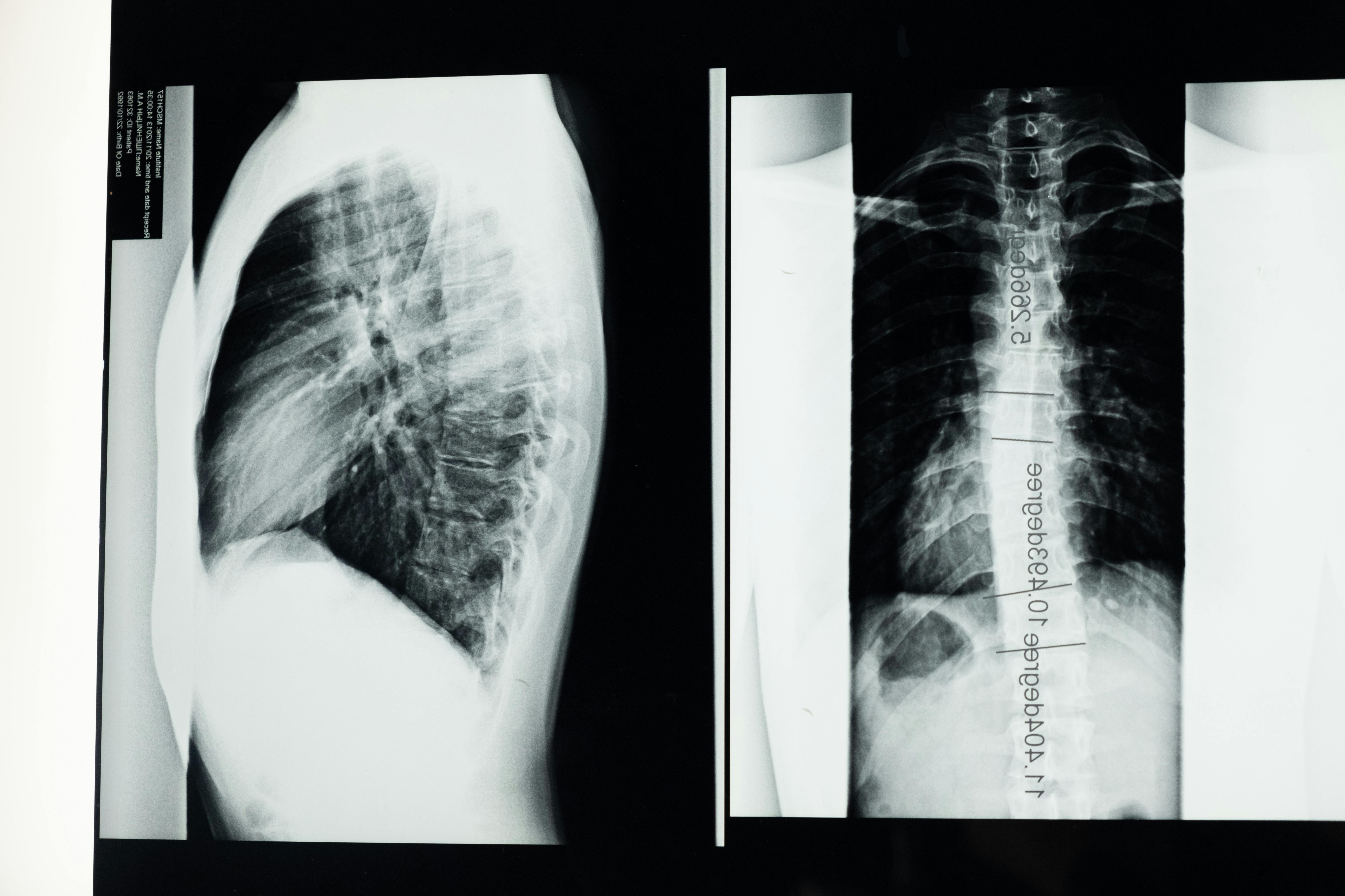 The spine analogy